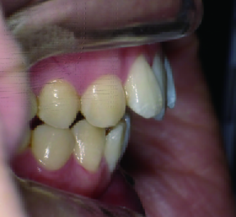 スプリント使用後、大きな出っ歯が明らかになったが外科を避けた症例について：初診時の状態 右アップ